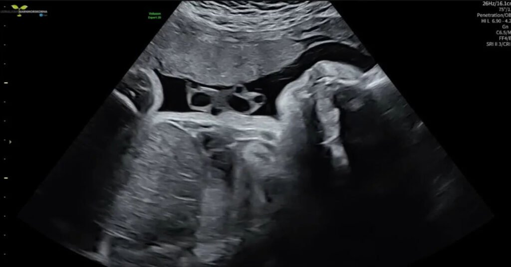 Reality star Jackie Ferm had no pregnancy symptoms for seven months