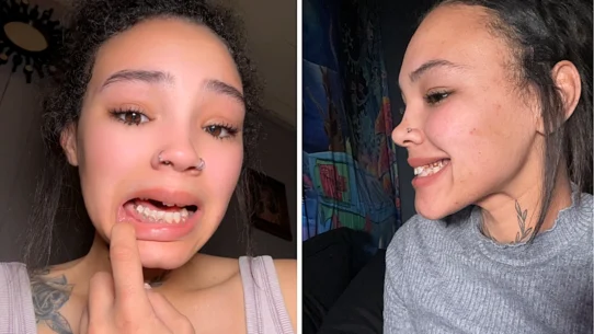 Shaylah Roberts says her teeth began rotting during pregnancy and are now beyond saving