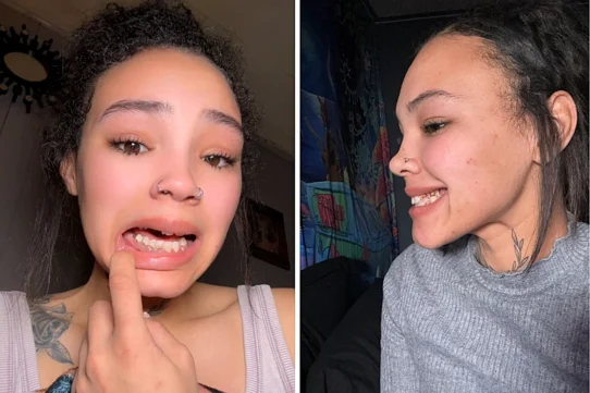 Shaylah Roberts says her teeth began rotting during pregnancy and are now beyond saving