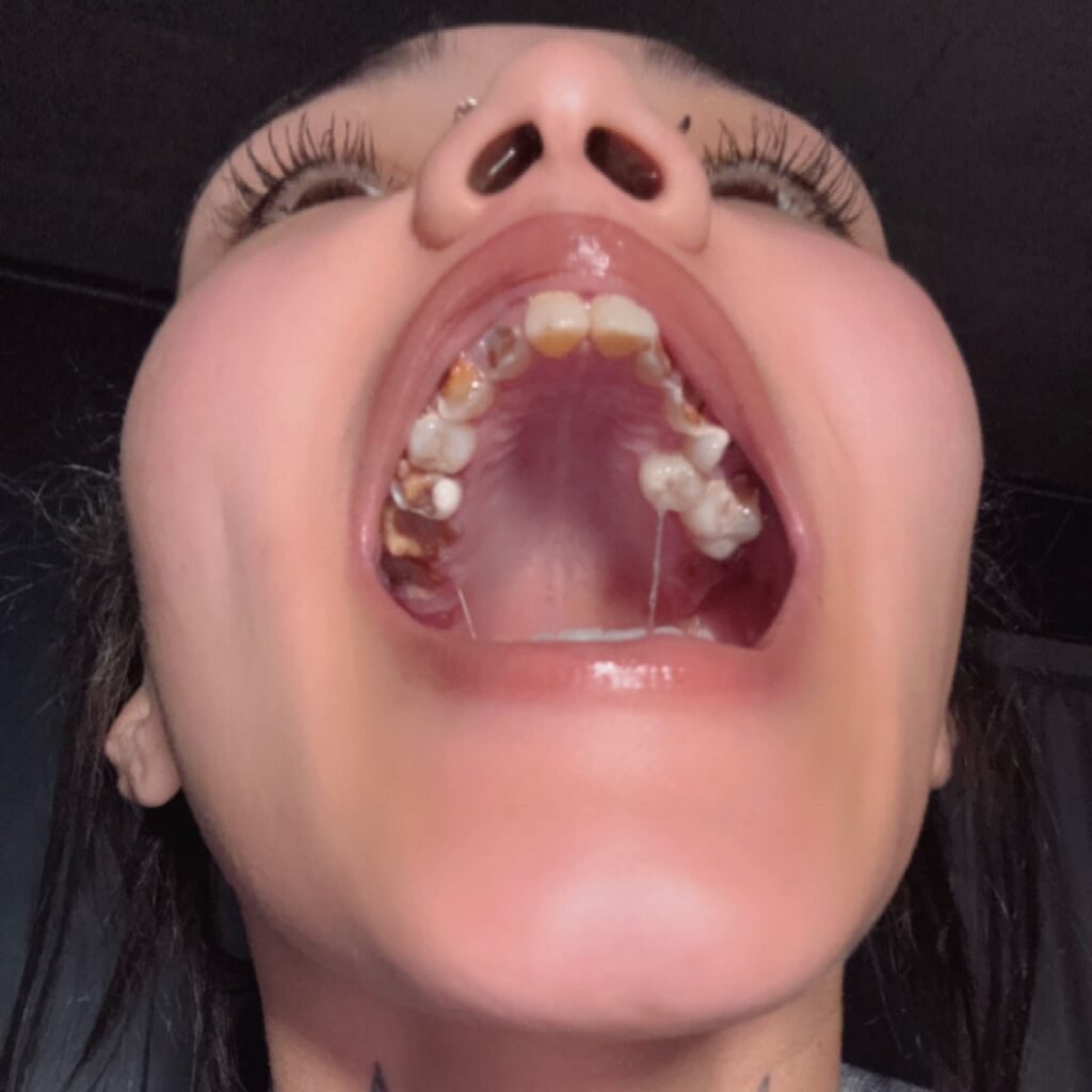 Shaylah Roberts says her teeth began rotting during pregnancy and are now beyond saving