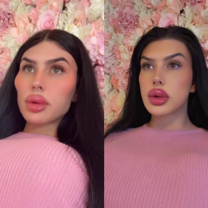 I'm known as 'Britain's biggest lips' – I dissolved my face filler for ...
