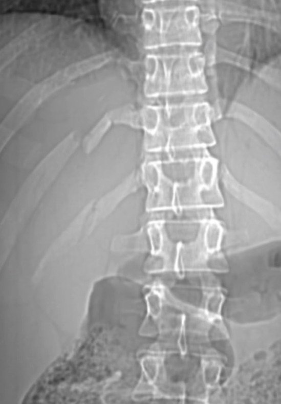 Influencer Carolina Braedt broke three ribs falling from her horse Igor while jumping an obstacle