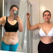 years – then faced a $100,000 bill for skin removal surgery