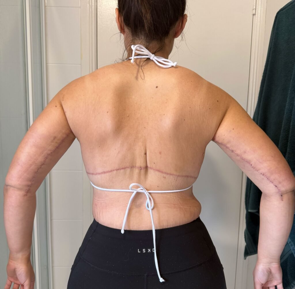 years – then faced a $100,000 bill for skin removal surgery