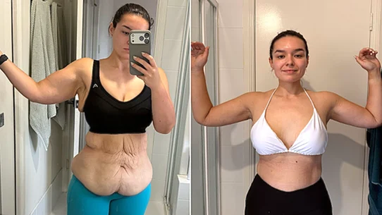 years – then faced a $100,000 bill for skin removal surgery