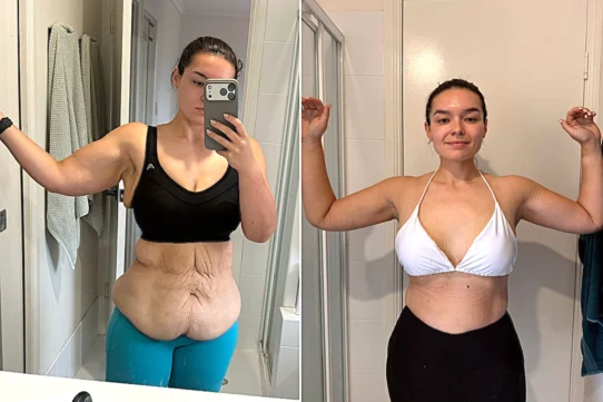 years – then faced a $100,000 bill for skin removal surgery