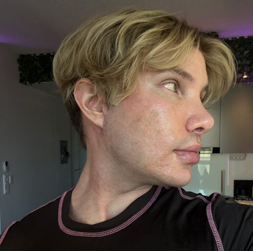 Big Brother Finland star Joni Hesselgren was refused a facelift in Turkey so flew to Seoul instead