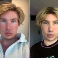 Big Brother Finland star Joni Hesselgren was refused a facelift in Turkey so flew to Seoul instead