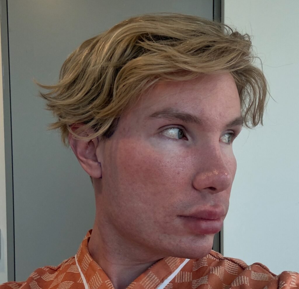 Big Brother Finland star Joni Hesselgren was refused a facelift in Turkey so flew to Seoul instead