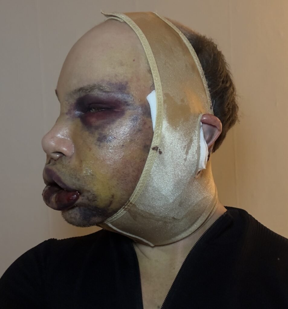 Big Brother Finland star Joni Hesselgren was refused a facelift in Turkey so flew to Seoul instead