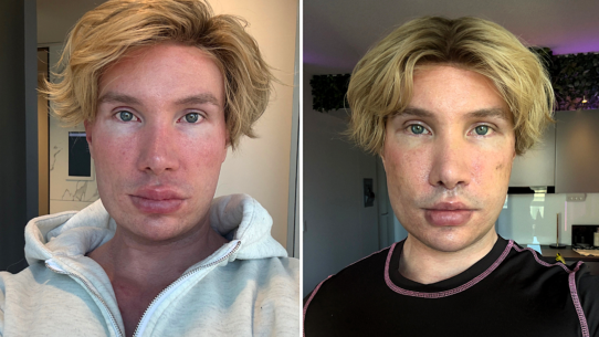 Big Brother Finland star Joni Hesselgren was refused a facelift in Turkey so flew to Seoul instead
