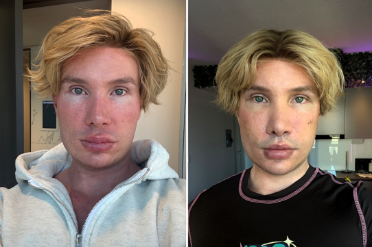 Big Brother Finland star Joni Hesselgren was refused a facelift in Turkey so flew to Seoul instead