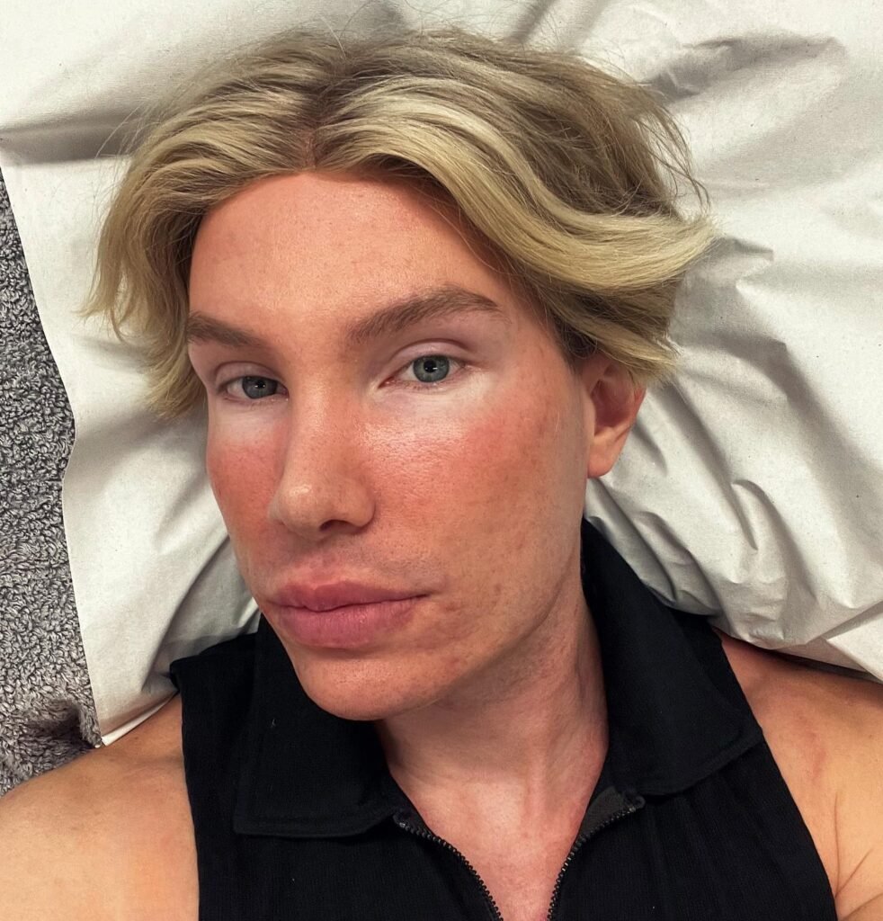 Big Brother Finland star Joni Hesselgren was refused a facelift in Turkey so flew to Seoul instead