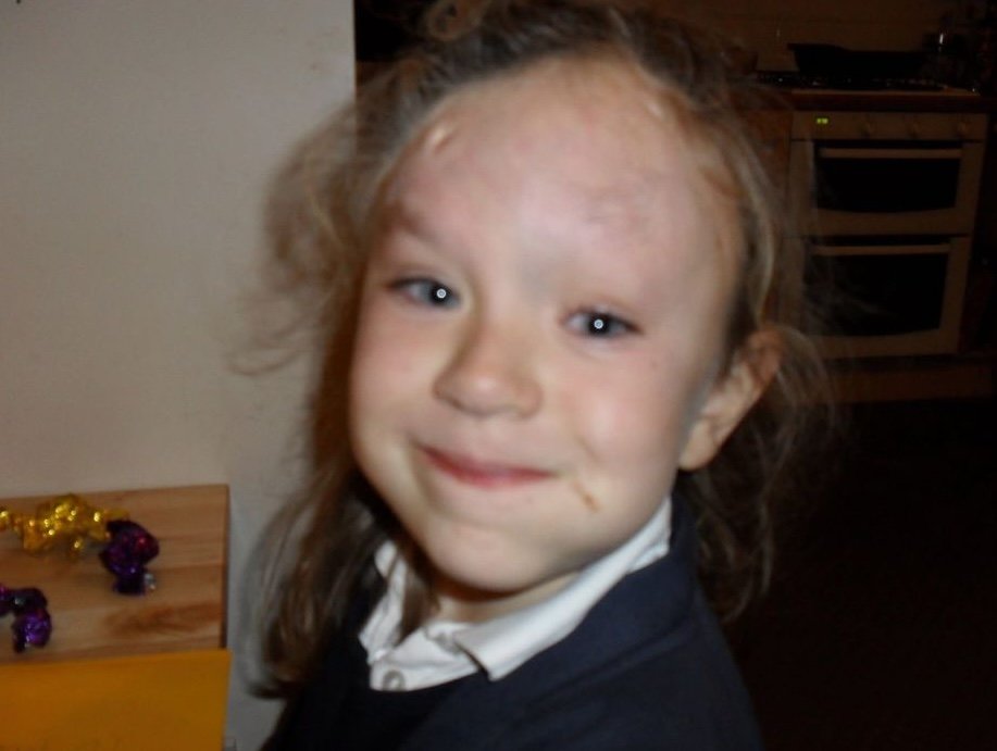 Kate Markham was born with a rare condition that causes folds in her skin