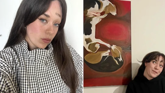 Kate Markham was born with a rare condition that causes folds in her skin