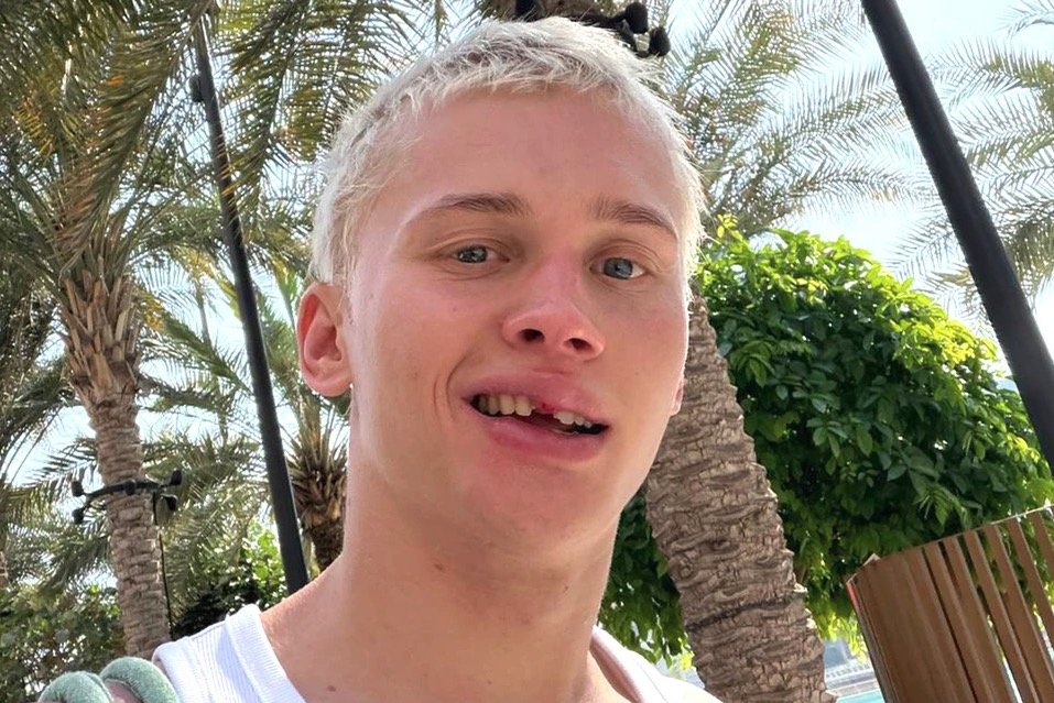 Russian influencer Dania Milokhin, 24, lost his front tooth on a children's pool slide in Dubai