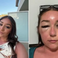 Phoenix McPike spotted a heavy eye bag on her Greek holiday