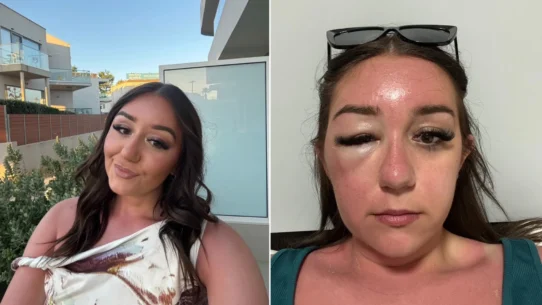 Phoenix McPike spotted a heavy eye bag on her Greek holiday