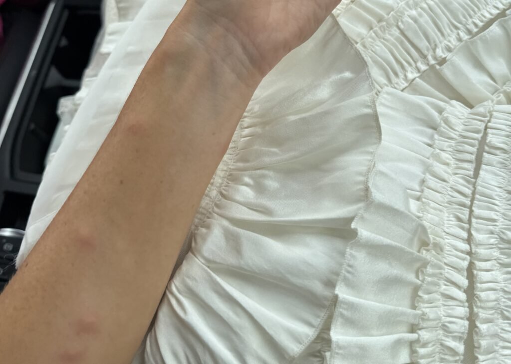Bride Auja Smith woke on her wedding morning covered in 50 swollen mosquito bites