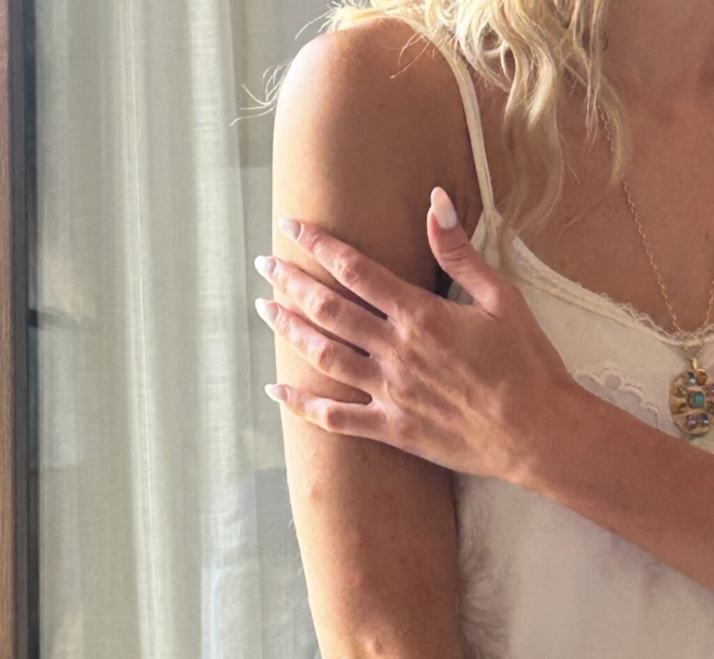 Bride Auja Smith woke on her wedding morning covered in 50 swollen mosquito bites