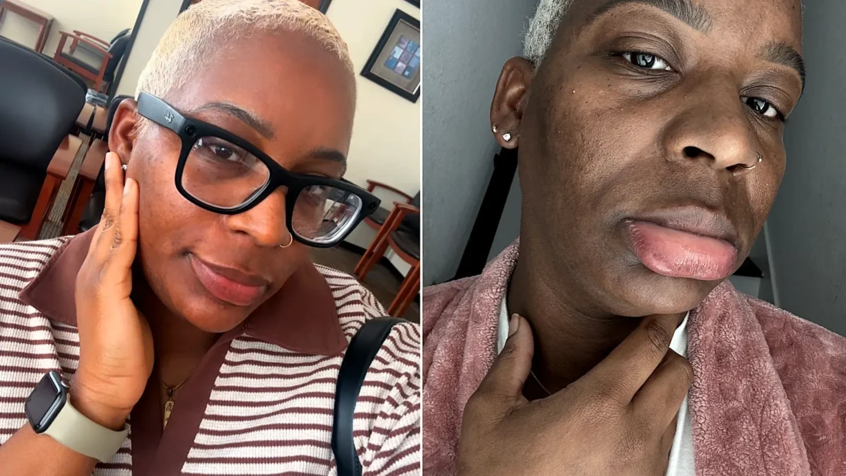 Kimberlee Mills is allergic to water. Her own tears cause hives, she washes her face once a month