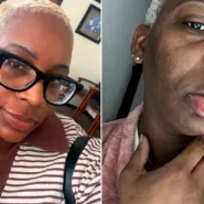 Kimberlee Mills is allergic to water. Her own tears cause hives, she washes her face once a month