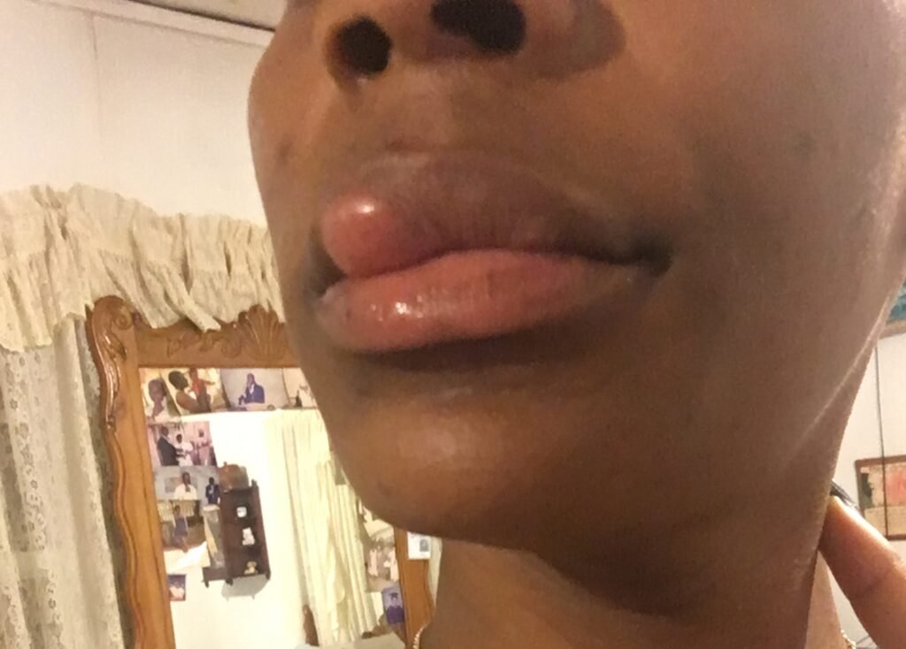 Kimberlee Mills is allergic to water. Her own tears cause hives, she washes her face once a month