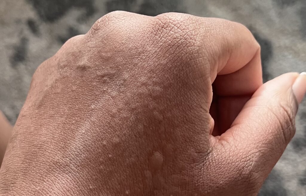 Kimberlee Mills is allergic to water. Her own tears cause hives, she washes her face once a month