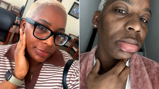 Kimberlee Mills is allergic to water. Her own tears cause hives, she washes her face once a month