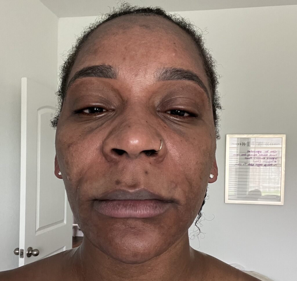 Kimberlee Mills is allergic to water. Her own tears cause hives, she washes her face once a month