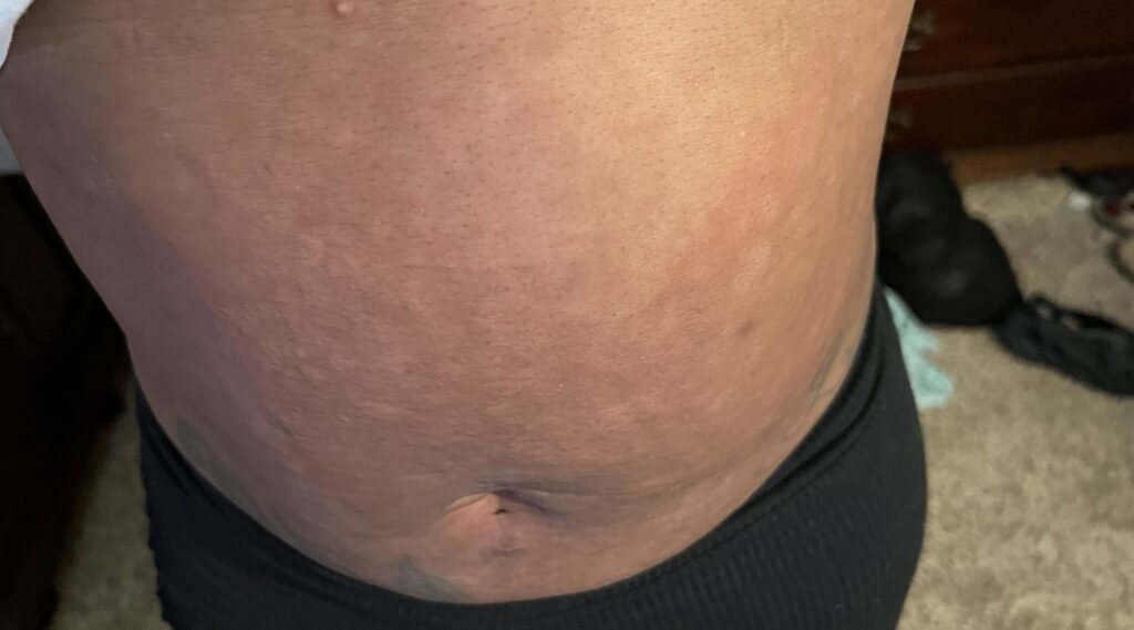 Kimberlee Mills is allergic to water. Her own tears cause hives, she washes her face once a month