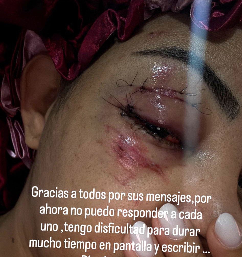 Influencer Yaritza Ortiz was hit by a speeding motorbike while filming in Santo Domingo