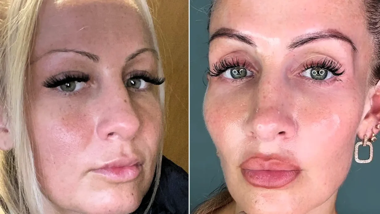 Kajsa Ziebell refused Botox to avoid a 'marshmallow face'