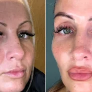 Kajsa Ziebell refused Botox to avoid a 'marshmallow face'