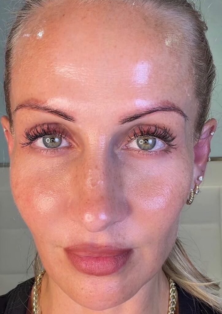 Kajsa Ziebell refused Botox to avoid a 'marshmallow face'