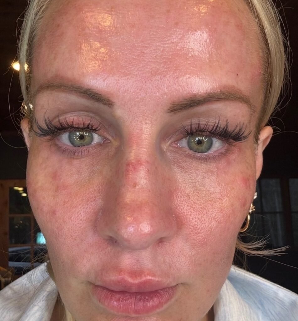 Kajsa Ziebell refused Botox to avoid a 'marshmallow face'